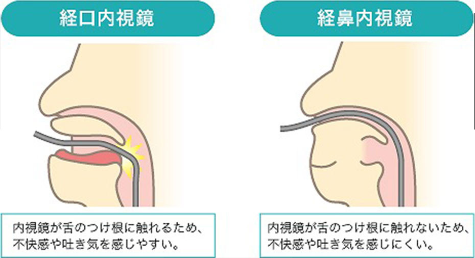 鼻からの胃内視鏡検査